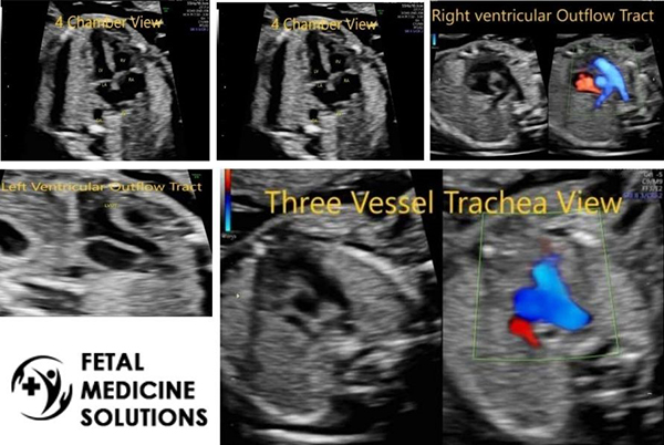 Fetal Echocardiography