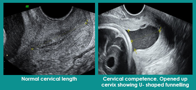 Cervical Length Screening