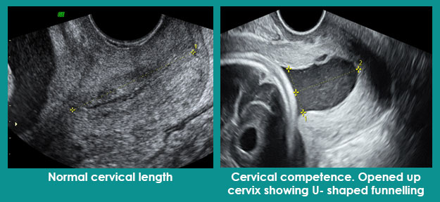 Cervical Length Chart