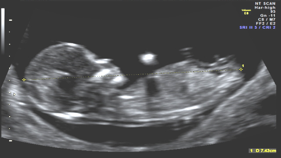 First Trimester Combined Screening